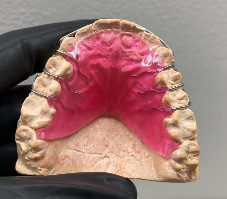 Aparelhos ortodônticos tradicionais e estéticos